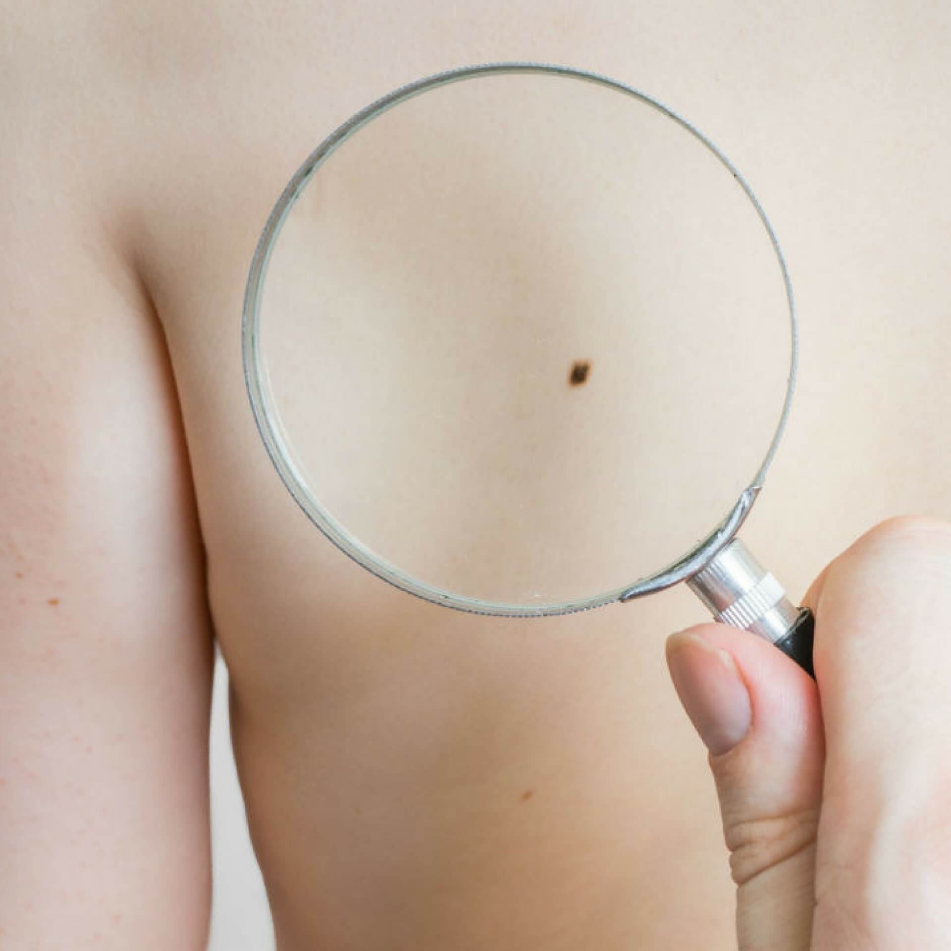 Supplement Use and Risk of Cutaneous Squamous Cell Carcinoma