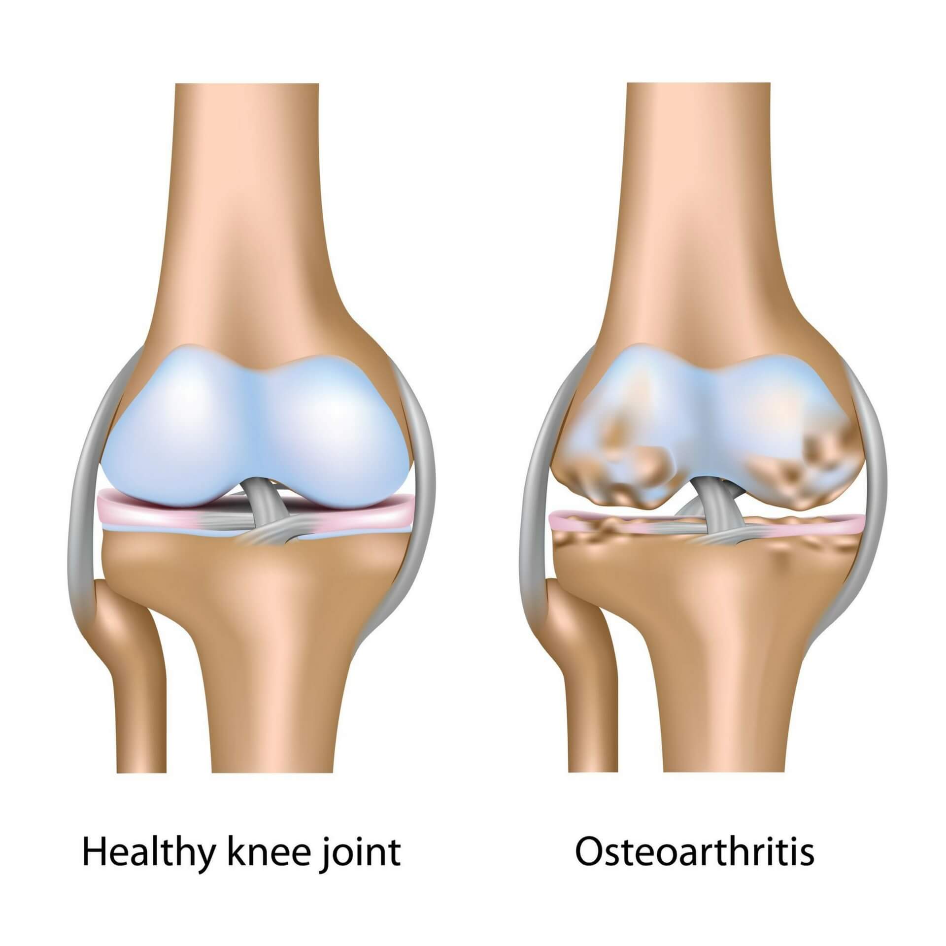 Effect of a glucosamine-based combination supplement containing chondroitin sulfate and antioxidant micronutrients in subjects with symptomatic knee osteoarthritis: A pilot study